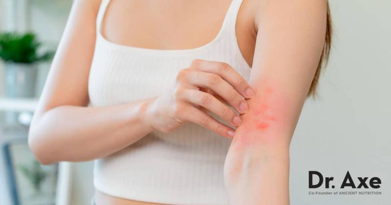 8 maneiras naturais de superar o eczema e a dermatite atópica