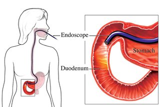 O que é endoscopia