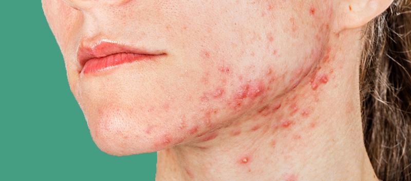 Leia seu rosto: 7 emoções que causam e agravam a acne