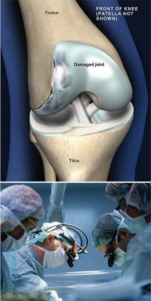 Estágio 1: Osteocondrose lombar leve