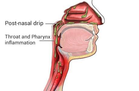 post_nasal_drip_en-1182354-3706721