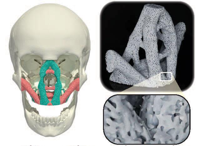 Os cientistas criaram implantes que saturam os ossos com elementos benéficos