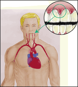 Como os dentes ruins afetam o coração?