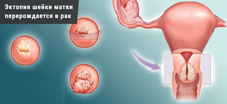 O que é erosão cervical?