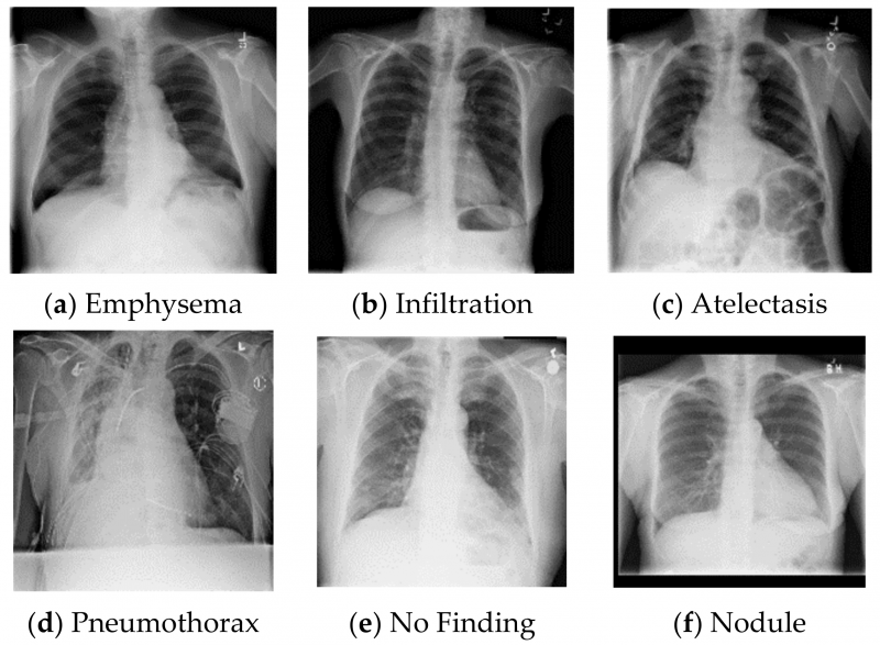 Rede neural aprendeu a diagnosticar doenças crônicas a partir de radiografias de tórax