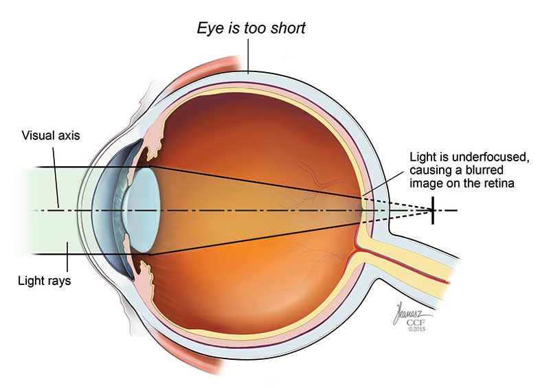 Causas inesperadas de deficiência visual (e como a miopia está relacionada aos pés chatos)