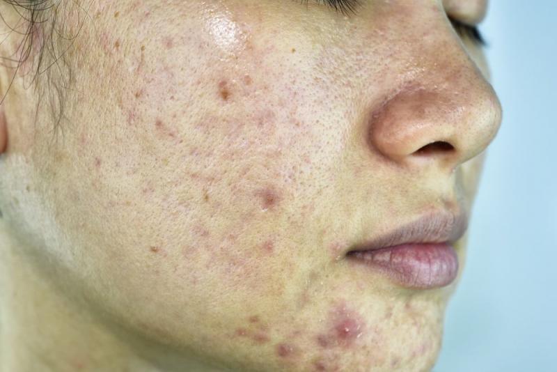 Acne em adolescentes