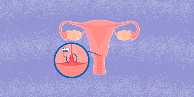 Pergunte a um ginecologista: qual é o perigo da erosão cervical?