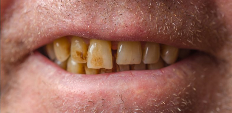 É possível clarear um dente em uma clínica?