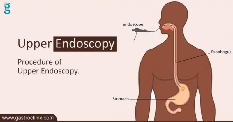 Como se preparar para a endoscopia