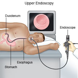 Endoscopia gástrica: o que é esse procedimento (e de quais doenças ele o salvará)