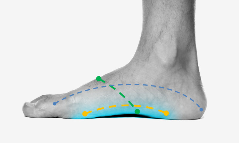 4. Neuroma