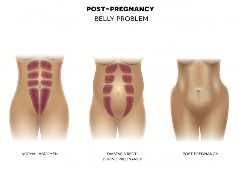 O que é diástase abdominal