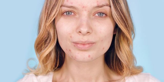 Acnepositive: uma nova tendência de maquiagem para quem tem pele menos que perfeita