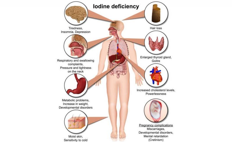 Deficiência de iodo no corpo: 20 sintomas perigosos