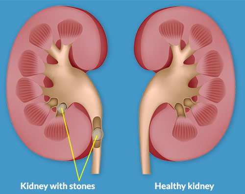 Perguntas ao urologista: como remover a areia dos rins