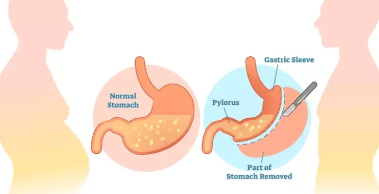 Bariátrica gástrica: o que é e quem realmente precisa dela