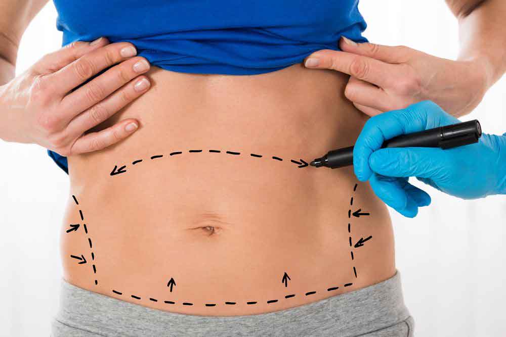 Lipoaspiração: 7 mitos mais populares (desfeitos por um cirurgião plástico)