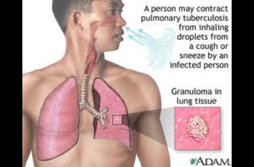 1 A tuberculose não é tão comum