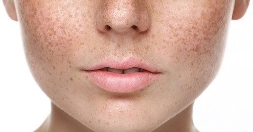 2. No local de elementos inflamatórios (acne, furunculose).