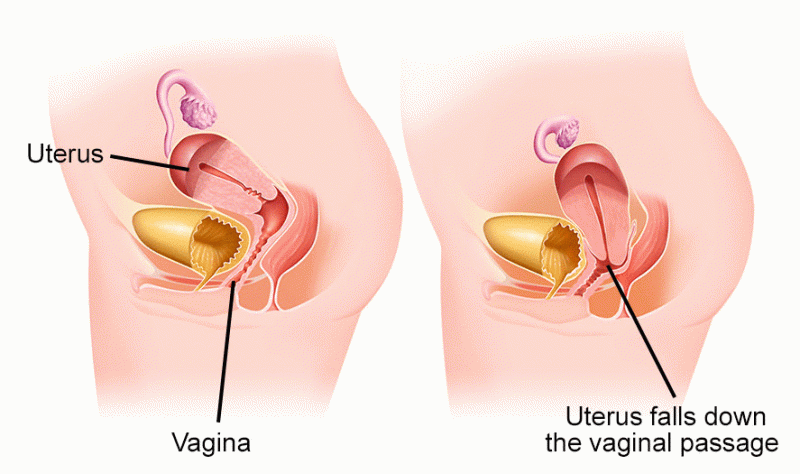 Tratamento cirúrgico do prolapso da parede vaginal