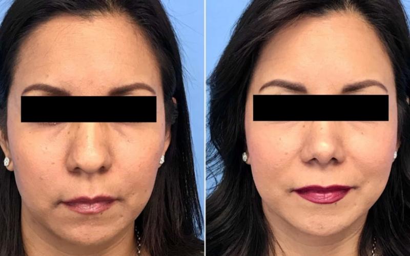 Rinoplastia moderna: tipos e características do procedimento