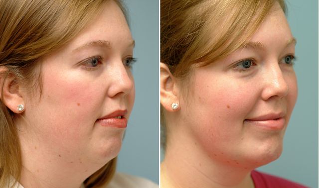 Lipoaspiração facial: eliminação do segundo queixo