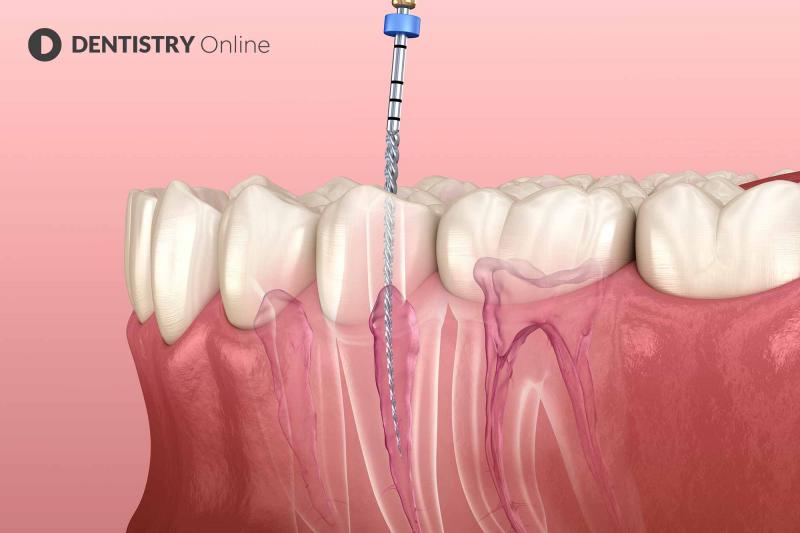 O que fazer com a raiz de um dente em diferentes casos?