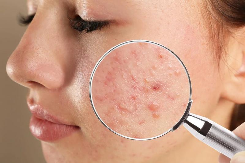 5 mitos sobre a acne em que você deveria parar de acreditar há muito tempo