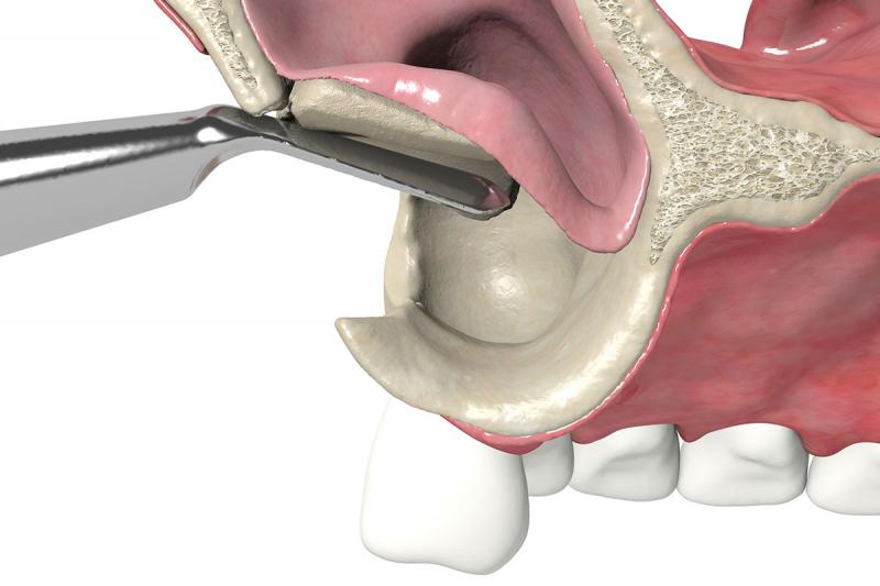 Cirurgia de elevação do seio maxilar: o que é?