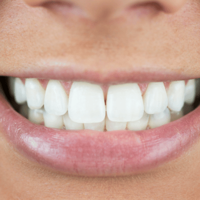 80% das extrações de dentes em pessoas com idade entre 40 e 50 anos são devidas a doenças gengivais.