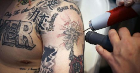 1 A tatuagem colorida não pode ser removida