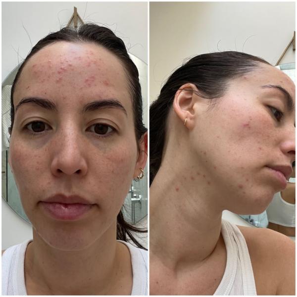 Como a acne foi combatida ao longo dos anos: da crioterapia às injeções de esteroides