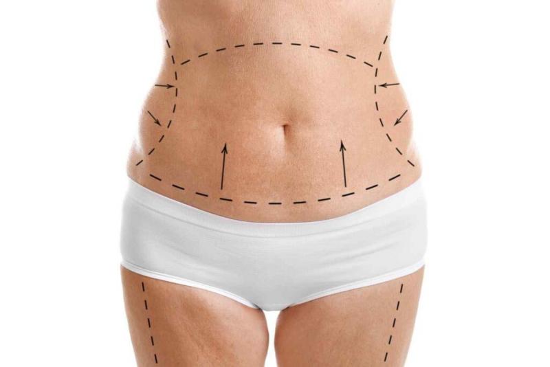 Anomalia na cintura: como obter a figura de uma modelo instantânea e se é necessário fazer cirurgia plástica
