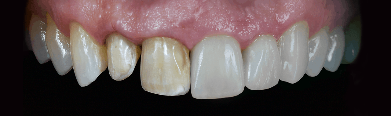 Benefícios das facetas em dentes saudáveis: