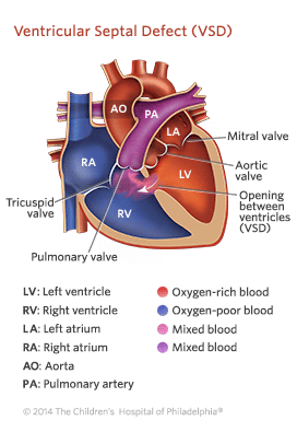 Sintomas de VSD