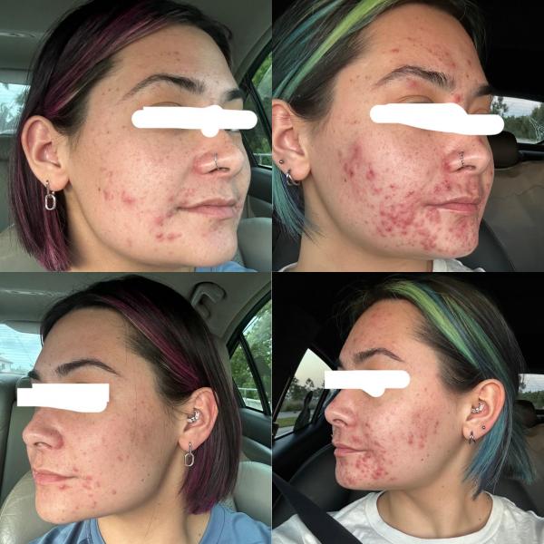 Já com rugas, mas ainda com acne: entendemos as causas da acne de início tardio