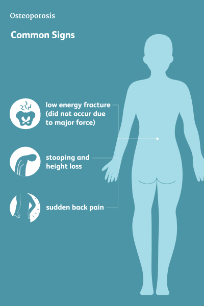 5 sintomas não óbvios da osteoporose que muitas pessoas ignoram