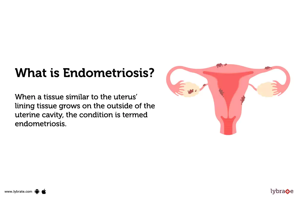 O que é endometriose, seus sintomas e tratamento