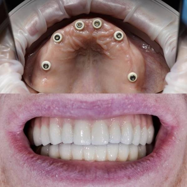 Todos os dentes em quatro implantes: Como recuperar seu sorriso com uma prótese completa