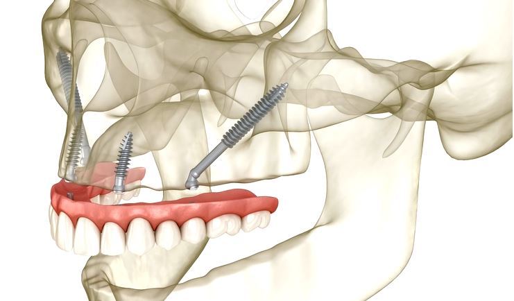 Implante dentário de osso da bochecha: o que é essa técnica e quem deve optar por ela?